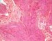 Plexiform schwannoma