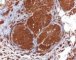 Plexiform schwannoma (S100)