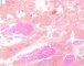 Plexiform schwannoma