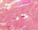 Plexiform schwannoma