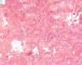 Plexiform schwannoma