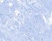 Plexiform schwannoma (NF)