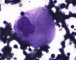 Gaucher cell in bone marrow cytology