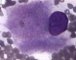 Gaucher cell in bone marrow cytology