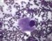 Gaucher cell in bone marrow cytology