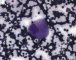 Gaucher cell in bone marrow cytology