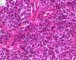 ovarian Leydig cell tumor