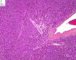 Ovarian Leydig cell tumor