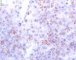 Ovarian Leydig cell tumor