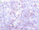 Ovarian Leydig cell tumor