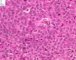 Ovarian Leydig cell tumor