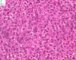 Ovarian Leydig cell tumor