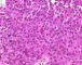 Ovarian Leydig cell tumor