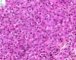 Ovarian Leydig cell tumor