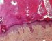 Warty keratosis in Rothmund-Thomson syndrome