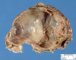 Abdominal cystic lymphangioma