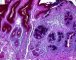 Intestinal metaplasia in stomach (ABPAS)