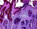 Intestinal metaplasia in stomach (chronic gastritis)