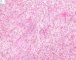 biliary tract embryonal rhabdomyosarcoma
