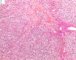 biliary tract embryonal rhabdomyosarcoma