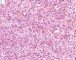 biliary tract embryonal rhabdomyosarcoma