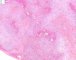 biliary tract embryonal rhabdomyosarcoma
