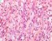 biliary tract embryonal rhabdomyosarcoma