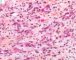 biliary tract embryonal rhabdomyosarcoma