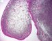 Botryoid embryonal rhabdomyosarcoma of the rhinopharynx