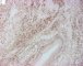 Botryoid embryonal rhabdomyosarcoma of the rhinopharynx (Myogenin)