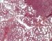 Acute bronchopneumonia