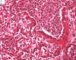 Acute bronchopneumonia
