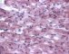 Cardiomyocytic microvesicular steatosis in an genetic metabolic (...)