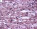 Cardiomyocytic microvesicular steatosis in an genetic metabolic (...)