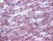 Cardiomyocytic microvesicular steatosis in an genetic metabolic (...)