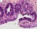 Biliary epithelial dysplasia in choledochal cyst