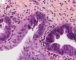 Biliary epithelial dysplasia in choledochal cyst