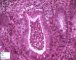 Cryptic abcess in Crohn active colitis