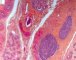 Testicular atrophy in cryptorchidism (Courtesy of B. Ellezam)