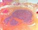 Testicular atrophy and fibrosis in cryptorchidism (Courtesy of B. (...)