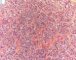 Germ cell reaction in cryptorchidism