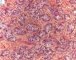 Germ cell reaction in cryptorchidism