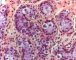 Germ cell reaction in cryptorchidism