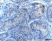 Germ cell proliferation in cryptorchidism (CD117)