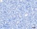 Germ cell proliferation in cryptorchidism (PLAP negative) (Courtesy of B. (...)