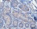 Germ cell proliferation in cryptorchidism (CD117) (Courtesy of B. (...)