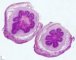 Meconial peritonitis after fetal intestinal perforation in cystic (...)