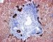 Cytokeratin-7 in ductular proliferation