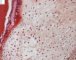 Enchondroma in Maffucci syndrome