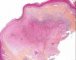 Epithelioid sarcoma
